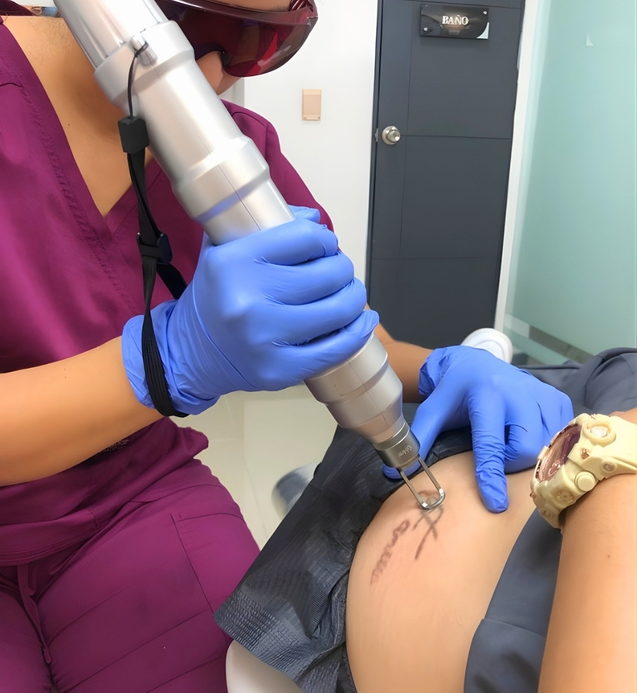 Retiro de tatuajes con láser